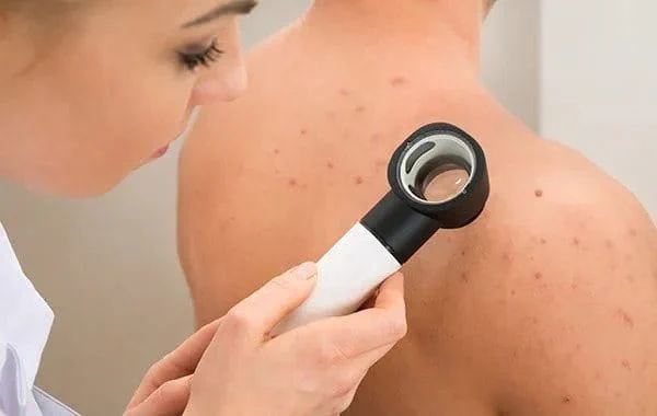 Acne Treatment initial consultation